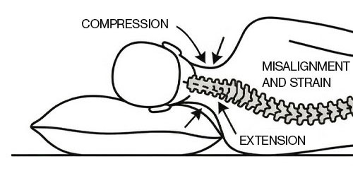 Spinal Alignment 1